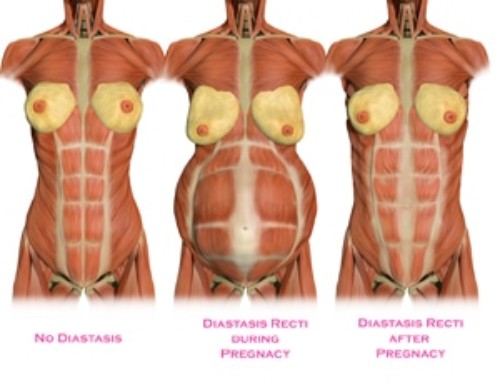 Diagnosing & Rehabing Diastasis Recti or “Mummy Tummy”